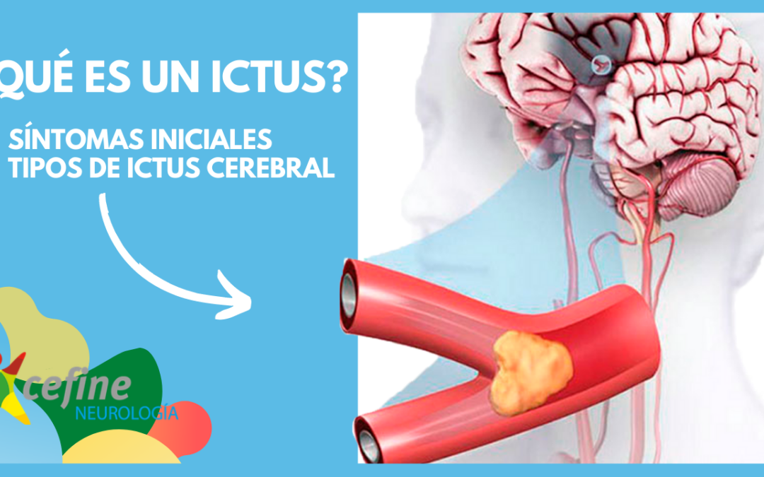 Qué es un Ictus Cerebral: tratamientos, síntomas, causas e información